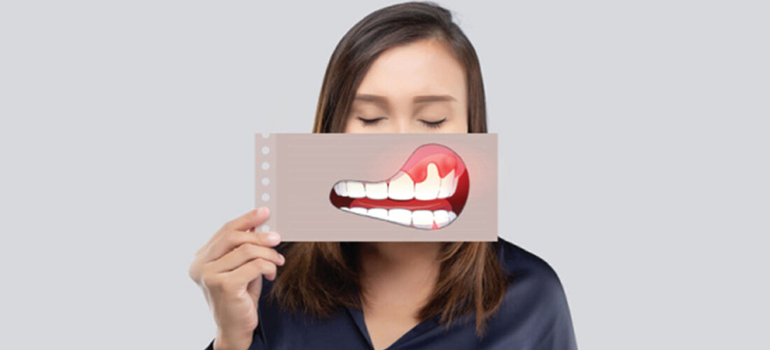 What-is-gum-disease-(periodontitis)