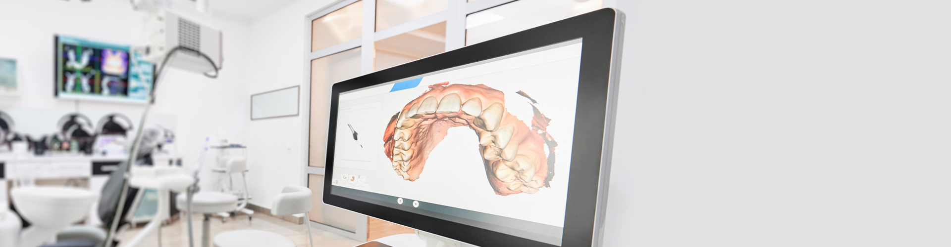 Itero-Inter-oral-Scanner