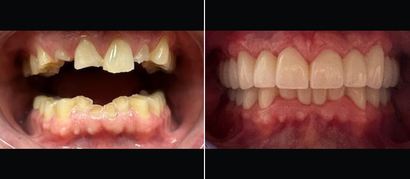 beforeafter13